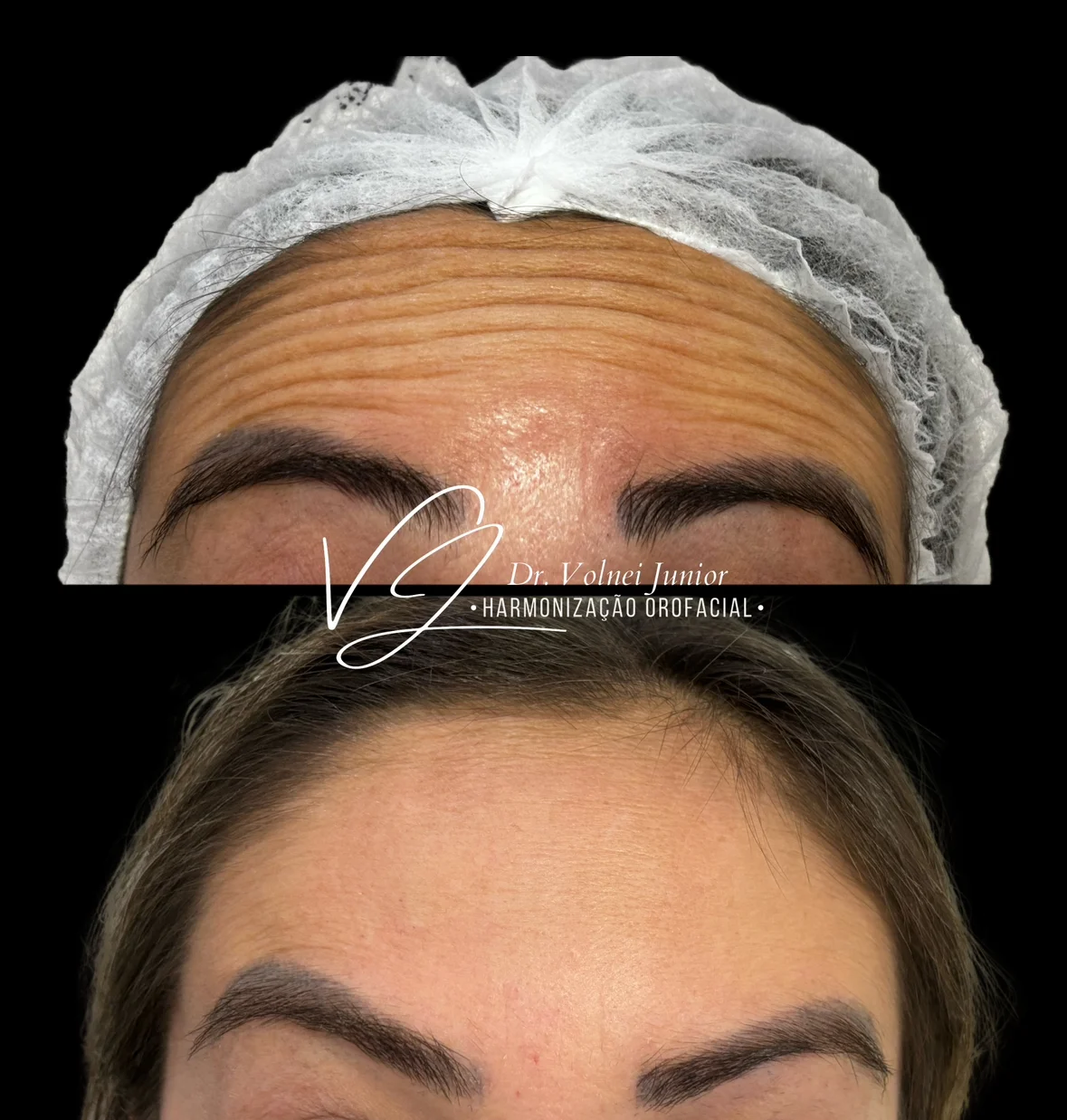 Botox